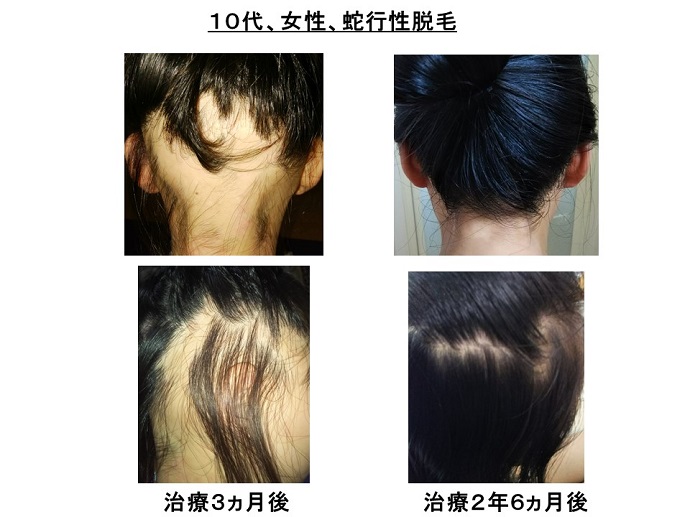 汎発性脱毛　病院